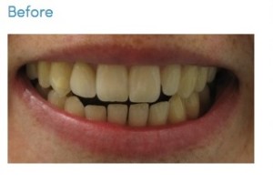 BeforeAfterTeethWhiteningLosAngeles-(23)